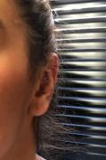 Otoplastie (Chirurgie esthétique des oreilles) - Cliché avant - Docteur Pierre Laur