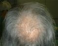 Traitements de la chute des cheveux - Cliché avant - Dr Gérard  COUREAU