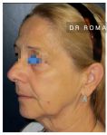 Lifting du cou - Lifting cervico facial chez une femme de 58 ans qui faisait plus âgée que son âge. L’intervention lui a permis de retrouver un visage plus harmonieux.