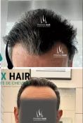 Greffe de cheveux - Cliché avant - Phoenix Hair Center