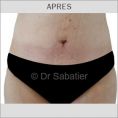Abdominoplastie - Cliché avant - Dr Henry Sabatier