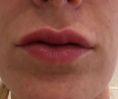 Augmentation des lèvres (acide hyaluronique) - Ourlet et augmentation légère de volume des lèvres supérieure et inférieure par injection de 0,55ml d’acide hyaluronique à la canule