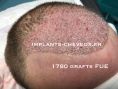 Greffe de cheveux par FUE - Technique FUE (unité folliculaire par unité folliculaire) sans cicatrice, nécessite une zone donneuse (derriere le crâne) suffisante pour être efficace. Jusqu