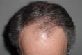 Greffe de cheveux - Cliché avant - Dr Jean-Luc COHEN