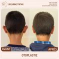Otoplastie (Chirurgie esthétique des oreilles) - Cliché avant - Dr Sirine Tritar