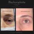 Blépharoplastie - Cliché avant - Dr Karim Bouzid
