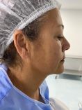 Dr. Gherissi Anas - Résultat à deux mois après lifting du visage et blepharoplastie supérieure et inférieure.