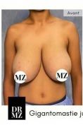 Lifting mammaire (Mastopexie) - Cliché avant - Professeur Mourad Zinelabidine