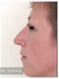 Génioplastie - Chirurgie esthétique du menton - Rhinoplastie de pointe et bosse : Résultat à 1 an de profil. À noter une génioplastie par transfert graisseux (au niveau du menton).
