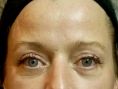 Lifting non chirurgical (Exilis) - Cliché avant - RS Esthétique - Centre d’amincissement & remodelage de la silhouette anti-âge visage et corps sans chirurgie