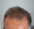Greffe de cheveux - Cliché avant - Dr Alain Berkovits