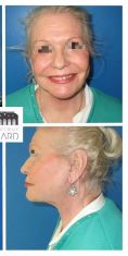 Mini lifting (lifting cervico-facial) - Patiente de 73 ans métamorphosée par un lifting cervico facial, blépharoplastie des 4 paupières et lipostructure faciale. Résultat à 6 mois. Notez la redéfinitition parfaite de son angle cervico mentonnier.