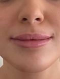 Augmentation des lèvres - acide hyaluronique: MD codes du Dr De Maio et Restylane Kiss. Pas de douleur. Pas d