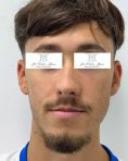 Génioplastie - Chirurgie esthétique du menton - Les décalages de classe 3 (prognathe mandibulaire / rétrognathe maxillaire) présentent souvent des asymétries faciales : déviation latérales du bas du visage, obliquité du sourire…. Il faut en tenir compte ! Résultat à 6 mois post ostéotomie Bimaxillaire