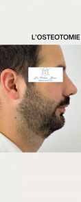 Génioplastie - Chirurgie esthétique du menton - Cliché avant - Dr Frédéric Barere