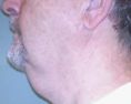 Lifting du visage - Cliché avant - Dr Christian Berwald