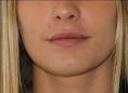 Augmentation des lèvres (acide hyaluronique) - Augmentation subtile du volume des lèvres et principalement de la lèvre supérieure, tout en restant dans une approche très naturelle