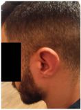 Otoplastie (Chirurgie esthétique des oreilles) - Cliché avant - Docteur Hayet Zitoun Esthétique