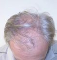 Greffe de cheveux - Cliché avant - Dr Christian Berwald
