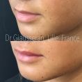Augmentation des lèvres (acide hyaluronique) - Cliché avant - Dr Fabien Giausseran
