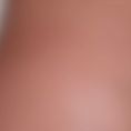 Harold Eburdery - Femme de 35 ans
Lipoaspiration ventre, flancs, dos, culotte de cheval, cuisses
Aspiration 3000cc
Technique SAFE (Separation, Aspiration, Fat Equalization) pour limiter les ecchymoses et les oedèmes et améliorer la régularité du résultat