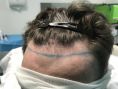 Dr Richard Amat Centre de Micro-greffe de cheveux FUE - Technique FUE micro greffe capillaire sans cicatrice et sans douleur