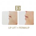 Augmentation des lèvres par Permalip - Cliché avant - Dr Franck Ouakil