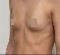 Augmentation mammaire (Implants mammaires) - Cliché avant - Dr Alexandre Mertens