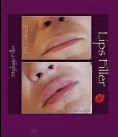 Augmentation des lèvres - Cliché avant - Dr Karim Bouzid