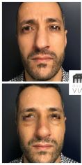 Rhinoplastie secondaire - Rhinoplastie réparatrice chez un homme se plaignant d’une déviation du nez et d’une bosse. A noter que la pointe a été traitée dans le même temps pour harmoniser le résultat. Résultat à 3 mois.