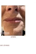 Augmentation des lèvres - Cliché avant - Dr Catherine de Goursac