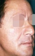 Rhinoplastie - Cliché avant - Dott. Andrea La Padula M.D.