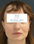 Dr Frédéric Barere - L’affinement du nez est visible sur les coupes de face, la diminution de la bosse sur celles de profil !
Résultat à 6 mois.