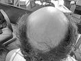 Greffe de cheveux - Cliché avant - Dr Hai Seroussi