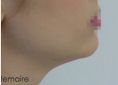 Chirurgie du double-menton - Résultat d’une liposuccion douce du cou chez une jeune femme de 26 ans.