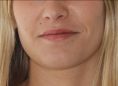 Augmentation des lèvres (acide hyaluronique) - Augmentation subtile du volume des lèvres et principalement de la lèvre supérieure, tout en restant dans une approche très naturelle