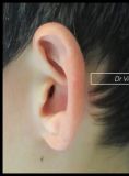 Otoplastie (Chirurgie esthétique des oreilles) - Cliché avant - Dr Romain Viard