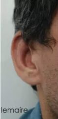 Otoplastie (Chirurgie esthétique des oreilles) - Résultat d’une otoplastie montrant l
