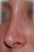 Rhinoplastie - Correction de la déviation de la cloison nasale et suppression de la bosse. Affinement de la pointe du nez