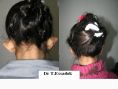 Otoplastie (Chirurgie esthétique des oreilles) - Cliché avant - Dr Tayeb Essadok