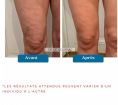 Traitement de la cellulite - Cliché avant