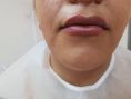 Augmentation des lèvres (acide hyaluronique) - Cliché avant - Médecin esthétique Docteur Ben Jerad Jihene