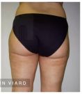 Augmentation et modelage des fesses et des hanches - Cliché avant - Dr Romain Viard