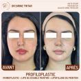 Rhinoplastie - Cliché avant - Dr Sirine Tritar
