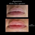 Augmentation des lèvres - Cliché avant - Dr Karim Bouzid
