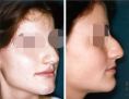 Rhinoplastie - Cliché avant - Dott. Andrea La Padula M.D.