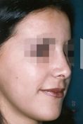 Rhinoplastie - Cliché avant - Dott. Andrea La Padula M.D.