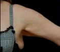 Lifting des bras - Cliché avant - RS Esthétique - Centre d’amincissement & remodelage de la silhouette anti-âge visage et corps sans chirurgie