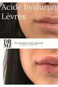 Augmentation des lèvres (injection de graisse) - Cliché avant - Professeur Mourad Zinelabidine