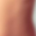 Dr Romain Viard - Gynécomastie majeure avec technique d’amputation greffe d’aréole, patient présentant des séquelles d’un amaigrissement massif. Anesthésie générale et hospitalisation de 2 nuits dans son cas. Cicatrices à distance cachées dans les poils du thorax.